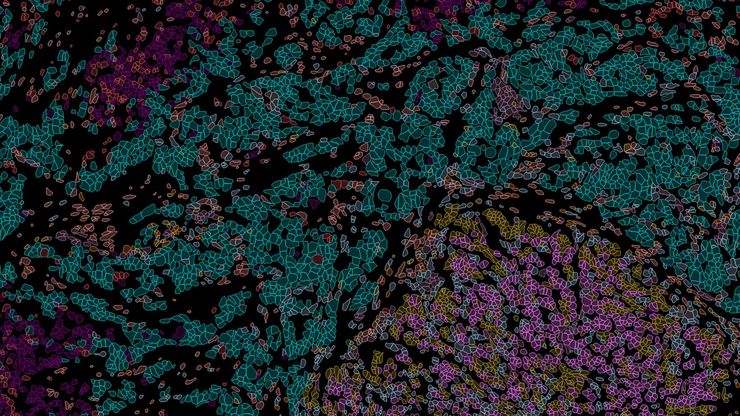 Pancreatic Ductal Adenocarcinoma imaged with Cell DIVE. Analysis done by Aivia. Pancreatic Ductal Adenocarcinoma imaged with Cell DIVE. Analysis done by Aivia.