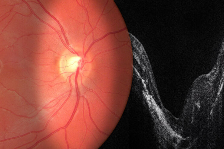 OCT-Guided Retina Surgery OCT-Guided Retina Surgery