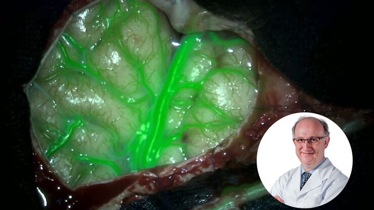 GLOW800 Augmented Reality fluorescence in Moyamoya disease treatment. Image courtesy of Prof. Dr. Feres Chaddad GLOW800 Augmented Reality fluorescence in Moyamoya disease treatment